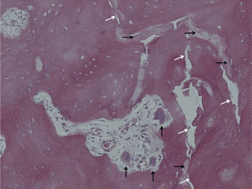 Figure 2. Histology of the fracture, seen both as a vertical crack through the image (white arrows) and as areas of diffusely damaged and disintegrated bone (black horizontal arrows). A resorption cavity with giant detached osteoclasts (black vertical arrows) and new-formed bone with rounded osteocytes can be seen near the fracture. (For higher resolution, see supplementary data).