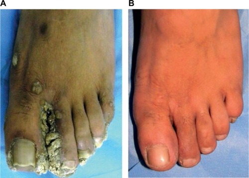 Figure 10 Cure of warts on feet: (A) before treatment and (B) after 5 months of treatment with MIP. Copyright ©2014. Reproduced from IJDVL. Singh S, Chouhan K, Gupta S. Intralesional immunotherapy with killed Mycobacterium indicus pranii vaccine for the treatment of extensive cutaneous warts. Indian J Dermatol Venereol Leprol. 2014;80:509–514.Citation18