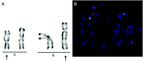 Figure 1.  Cytogenetic and FISH results of the carrier with balanced reciprocal translocation. A) Partial GTG-banding karyogram showing the t(3;6)(q21;q23) rearrangement. Arrows indicate the abnormal chromosomes. B) FISH analysis on methaphase chromosomes with three color DNA probes for centromeric region of chromosome 3 (CEP3) (red), chromosome 6 (CEP6) (blue), and 3qtel region (green). One green signal (3qter) and one blue signal (CEP6) on the same chromosome confirm the translocation between chromosome 3 and 6.