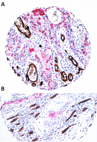 Figure 1. Sprouting angiogenesis surrounding COX-2 positive oral squamous cell carcinoma in deep invasion. 1a, 1b. Two representative OSCCs with over-expression of COX-2, that is accompanied by the formation of new CD-34-positive vessels (LSAB-HRP, nuclear counterstaining with hematoxylin; original magnification x100).