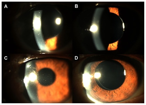 Figure 1 Slit-lamp photos of the left eye of a patient with anterior segment inflammation from cytomegalovirus. (A) Prior to commencement of valganciclovir, there were diffuse multiple pigmented keratic precipitates on the cornea. (B) Four weeks after valganciclovir therapy, the keratic precipitates completed resolved with absence of inflammation in the anterior chamber. (C) One month after stopping valganciclovir therapy, the was recurrence of keratic precipitates on the cornea with mild anterior chamber inflammation. (D) Two weeks after recommencing valganciclovir, the keratic precipitates again resolved with no inflammation in the anterior chamber.