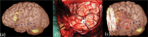 Figure 8. Clinical implementation. (a) Volume rendering of the anatomical MR volume and functional activation map. (b) Intraoperative photograph of left temporal lobe. (c) Overlay of the photograph on the volume rendering of the anatomical MR volume and functional activation map.