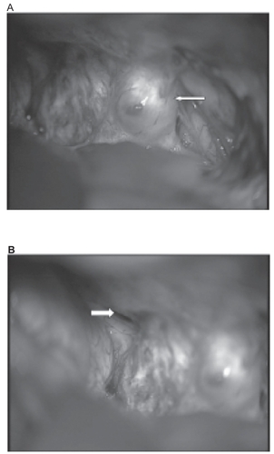 Figure 4 A) Intraoperative photograph after pterional approach from the right-hand side and splitting of the sylvian fissure: blue scarring in the region of lamina terminalis can be seen together with a bulging and thinning of the right-hand optic nerve (arrow). B) Intraoperative photograph after pterional approach from the right-hand side: the focused contralateral yellow optic nerve (arrow) seems uninvolved by the lesion with normal vascularization.