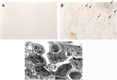 Figure 6 Apoptosis in COPD pathogenesis.