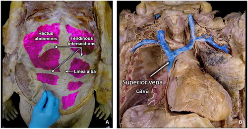Figure 2. Screenshots to show digital highlighting and labelling of structures. Note that post-production edits were achievable without training and with widely available software. A) Image from video 3 showing highlighting of rectus abdominus and related features. B) Image from video 4 showing great veins highlighted in blue.