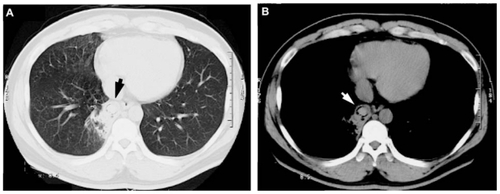 Figure 2 Chest computed tomography ([A] chest lung image, [B] chest tissue image) showing infiltration and a lung ball shadow (arrow) in the right lower lung field.