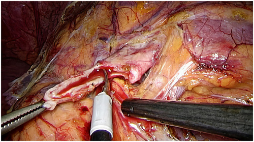 Figure 2 Anderson-Hynes dismembered procedure: the renal pelvis is circumferentially transacted above the UPJO.