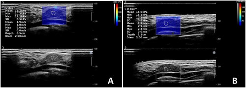 Figure 1. Images of breast lesions measured by SWE using two methods. (A) Using coupling gel. (B) Using a gel pad.