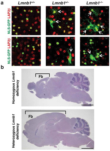 Figure 6. Identifying nuclear membrane ruptures in cultured cells does not always predict pathology in mouse models. (a) Confocal micrographs of NLS-GFP–expressing Lmnb1+/+, Lmnb1+/–, and Lmnb1–/– neurons as they migrate away from cultured neurospheres, revealing nuclear membrane ruptures [escape of NLS-GFP (green) into the cytoplasm] in both Lmnb1+/– and Lmnb1–/– neurons. Ruptures were more frequent in Lmnb1–/ – neurons than in Lmnb1+/– neurons. The neurons were stained with antibodies against LAP2β (red), an inner nuclear membrane protein. White arrows point to cells with nuclear membrane ruptures. Scale bars, 10 μm. (b) Homozygous loss of Lmnb1 in the forebrain in forebrain-specific Lmnb1 knockout mice markedly reduces forebrain size; heterozygous loss of Lmnb1 in the forebrain does not [Citation24]. Brackets indicate the forebrain (Fb). Scale bars, 200 μm. Images in panel b reproduced, with permission, from Coffinier et al. [Citation24].