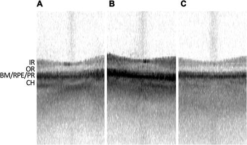 Figure 1 Representative swept-source OCT of normal foveas. (A–C) Representative IOLMaster 700 SS-OCT of three different non-pathological foveas, with inner retinal (IR) layers, outer retina (OR) layers, Bruch’s Membrane (BM), retinal pigment epithelium (RPE), photoreceptor layer (PR), and choroid (CH) layer denoted.