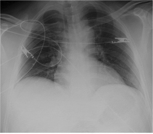 Figure 1. AP radiograph of the chest demonstrates no focal consolidation or effusion