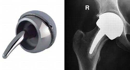 Figure 1. The Mitch proximal epiphyseal replacement (PER).