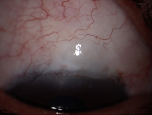 Figure 2 Morphologic characteristics of diffuse low-lying, avascular anterior bleb at 1 month after surgery.