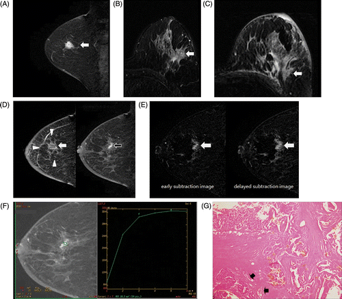 Figure 3. Partial ablation in a 68-year-old woman (patient 4 mentioned in Table II). (A) An early post-contrast sagittal T1-weighted image prior to HIFU showed a 15 mm irregular enhancing mass (arrow). (B) An axial fat suppressed T2-weighted image prior to HIFU revealed an isointense index tumour (arrow). (C) An axial fat suppressed T2-weighted image of MRI post-HIFU showed an isointense index tumour (arrow) with mammary oedema. (D) An early post-contrast sagittal T1-weighted image of MRI post-HIFU revealed an index tumour, isointense to adjacent parenchyma (arrow) surrounded by an ablation zone of decreased signal intensity (arrowheads). Irregular enhancement was seen at the periphery of the ablation zone (black arrow). (E) A central dark signal intensity and a nodular or irregular thick enhancement (arrow) was observed on the early and delayed subtraction image of MRI post HIFU. (F) Kinetic curve pattern showed early rapid enhancement and delayed persistent pattern. (G) Photomicrograph of a mastectomy specimen showing prevalent coagulative necrosis and a small portion of viable tumour (arrows) (H and E, original magnification × 40).