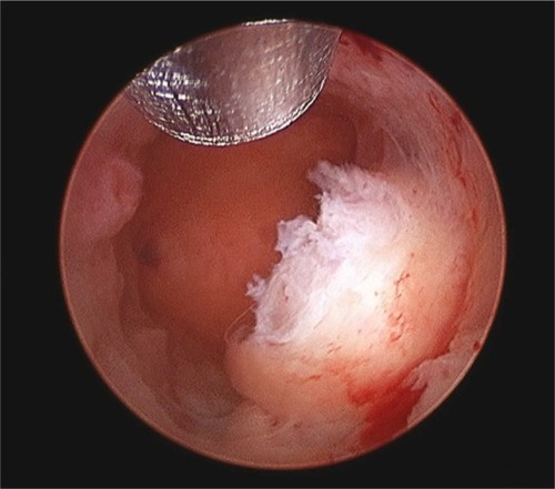 Figure 3 Hysteroscopic image of the MyoSure® tissue removal device in the uterine cavity.