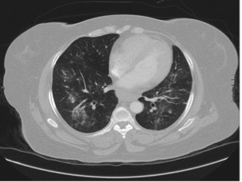 Figure 1. CT angiography. New widespread bronchoalveolar nodular consolidation with surrounding ground glass appearance.