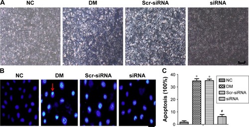 Figure 6 HMGB1 siRNA inhibits HREC apoptosis induced by high glucose in vitro.Notes: *P<0.05 versus NC group; #P<0.05 versus Scr-siRNA group. (A) Cell morphology in different groups (bar 25 μm). HRECs were treated with HMGB1 siRNA and Scr-siRNA for 12 hours, and then cultured under high glucose (30 mM/L) for 48 hours. The morphology of normal cells was uniform and spindle-shaped, and cells treated with high glucose became smaller and fewer. The cell state of the siRNA group was improved compared with the DM and Scr-siRNA groups. (B) Cell nuclear morphology after Hoechst 33342 staining (bar 25 μm). Apoptotic nuclei were stained bright blue. Apoptotic nuclei were densely stained and with crescent condensation. Red arrows show the nuclei of apoptotic cells. (C) Cell viability in different groups. HMGB1 siRNA pretreatment significantly inhibited cell apoptosis under a high-glucose environment.