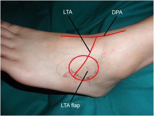 Figure 1 The anatomy of LTA and LTA flap.