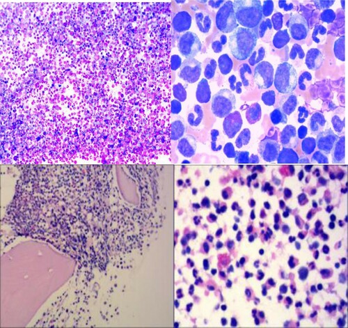 Figure 1. (A) Bone marrow aspirate: numerous granulocytes without dysplasia. Wright stain (100×). (B) Wright stain (1000×). (C) Bone marrow biopsy: hypercellular particle with granulocytic predominance. Hematoxylin and eosin stain (100×) and (D) hematoxylin and eosin stain (400×).