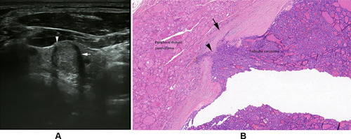 Figure 2 Follicular thyroid carcinoma of the left thyroid in a 66-year-old male. (A) Longitudinal sonogram indicates an isoechoic nodule with a thick, irregular, homogeneous and markedly hypoechoic halo (arrow) and the interruption of halo because of tumor invasion (arrowhead). (B) Photomicrograph shows tumor invasion into and through the hyalinized capsule (arrowhead) and the thick and irregular capsule (arrow). Mixed growth pattern can be observed in follicular carcinoma. High cellularity can be observed in the tumor of invasion into the capsule (H and E, × 40).