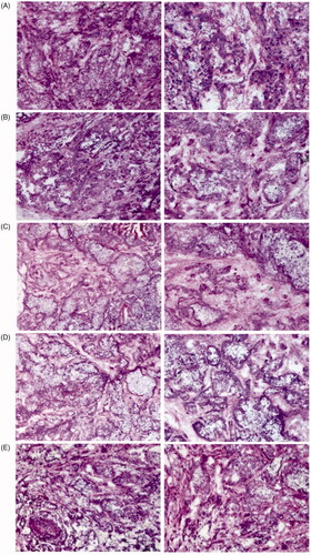 Figure 10. H&E-stained tumor tissues harvested from mice after different treatments. (A) Saline; (B) INEI (40%NBCA); (C) TC-E-5003-40%NBCA; (D) Epirubicin-40%NBCA; and (E) TC-E-5003.