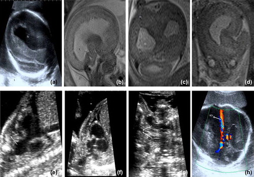 Figure 1. (a) Transverse view of the fetal head, showing marked enlargement of the right cerebral hemisphere and its shift to the left across the middle line. (b–d). Sagittal, coronal and axial single-shot, fast spin-echo T2-weighted MR images, revealing a markedly enlarged right cerebral hemisphere, a dilated right lateral ventricle (V) and a thickened parieto-occipito-temporal cerebral cortex. (e) Fetal longitudinal right parasagittal view, showing marked dilation of the superior vena cava (SVC), which measures nearly three times the diameter of the inferior vena cava. (f) Fetal longitudinal left parasagittal view, showing marked dilation of the ascending aorta and brachiocephalic and left common carotid arteries. (g) Coronal view of the fetal neck, revealing marked dilation of the bilateral internal jugular vein. (h) Transverse view of the fetal head, showing the middle cerebral artery and the circle of Willis, with the Doppler gate positioned in the middle cerebral artery. High-velocity flow of approximately 90 cm/sec was recorded in the middle cerebral artery. RV, Right ventricle; RH, Right hemisphere; V, Ventricle; F, Falx cerebri; IVC, Internal vena cava; SVC, Superior vena cava; LBV, Left brachiocephalic vein; BCA, Brachiocephalic artery; LCA, Left common carotid artery; LSA, Left subclavian artery, IJV, Internal jugular vein; MCA, Middle cerebral artery.