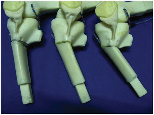 Figure 1. Bone models in varus with various degrees of deformity.