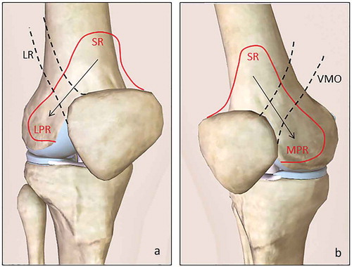 Figure 1. Schematic drawing shows the ‘squeeze effect’ of the lateral retinaculum on the lateral side (a) and the vastus medialis obliquus muscle on the medial side (b) over the supra-patellar recess with peripheral dislocation of the joint fluid to the para-patellar recesses.SR: supra-patellar recess, LR: lateral retinaculum, LPR: lateral para-patellar recess, VMO: vastus medialis obliquus muscle, MPR: medial para-patellar recess.