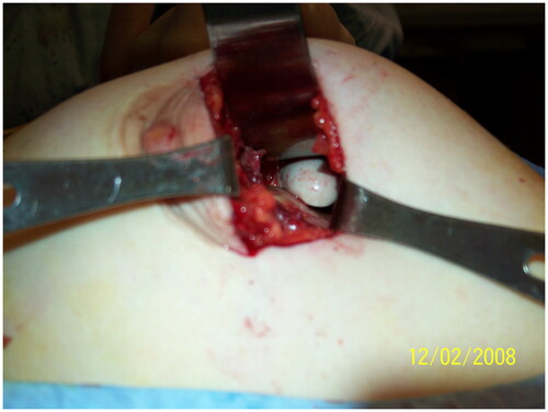 Figure 3. Tunneling between the left and right breast implant spaces as demonstrated by surgeon’s index finger crossing the midline.