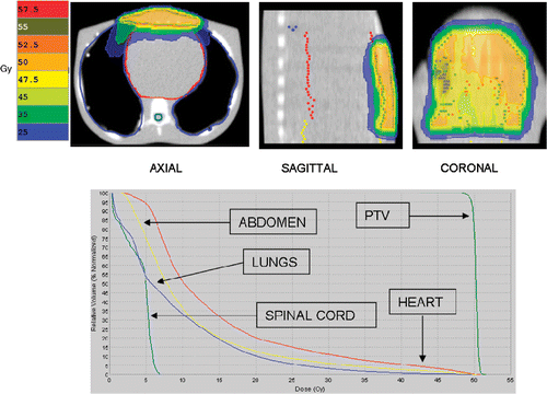 Figure 9. Isodose distribution (over 25 equal fractions) and dose-volume histogram for the superficial planning target volume (PTV) without the SURLAS.