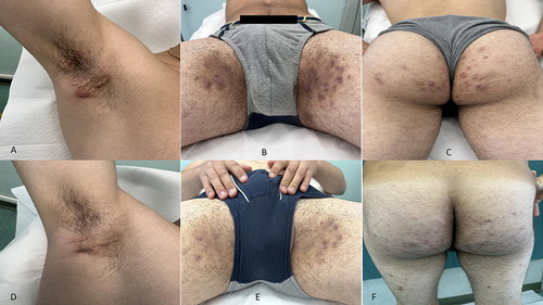 Figure 1 (A–C) Patient at baseline (D–F) Patient after 52-week of treatment with Guselkumab.
