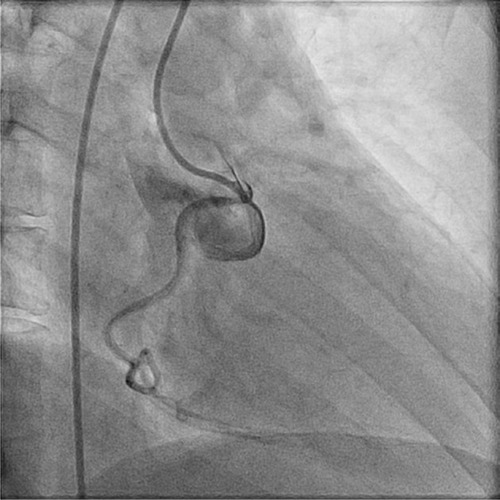 Figure 2 Real-time coronary catheterization fluoroscopic image demonstrating unilateral origination of both coronary arteries.