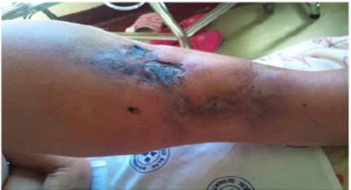 Figure 1 Skin manifestation of calciphylaxis. Left distal leg at the first predialysis visit.