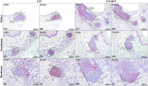 Figure 5. Histomorphometrical and immunohistochemical (CD3-PAX5) TLO/MALT evaluation comparing LVI (A,B,E,F,I,J) and LVI-HVI (C,D,G,H,K,L) groups as regards kidney (A,B,C,D), oesophagus (E,F,G,H), duodenum (I,J,K,L). Total length and width were measured histomorphometrically by means of CD3 immunohistochemistry; 100x (A,C,E,G,I,K). Germinal centre length and width were obtained using PAX5 immunohistochemistry; 100x (B,D,F,H,J,L). Higher histomorphometric values were observed in the LVI-HVI group. Brown immunolabelling is indicated by arrowheads.