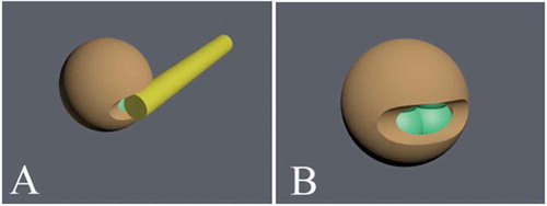 Figure 1. Laser assisted hatching in a cleavage-stage embryo. The laser is used for zona pellucida thinning or creation of a hole in the zona pellucida. This technique helps the embryo to escape from zona pellucida before implantation. For laser assisted hatching, the beam power is set at ≤300 mW with a pulse duration of ≤800 µs and a single opening of 30 µm in length (about 10% of the ZP circumference) is created. Two to three laser diode pulses are used to thin the zona pellucida or create a hole (10–30 µm). The laser beam is shot from one side (A) and creates a hole (B).