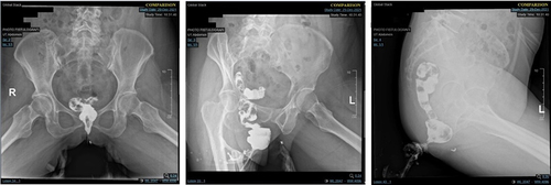 Figure 1 Fistulography with contrast.