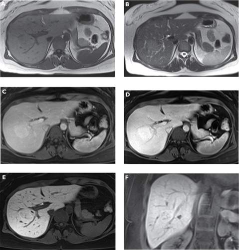 Figure 2 Focal nodular hyperplasia (FNH). Plain T1-weighted spoiled 2D gradient echo (GRE) A) T2-weighted half-Fourier acquisition single-shot turbo spin-echo (HASTE) B) arterial-phase gadoxetic acid-enhanced fat-suppressed (FS) T1-weighted spoiled 3D GRE C) portal venous-phase gadoxetic acid-enhanced FS T1-weighted spoiled 3D GRE D) hepatocellular phase in the axial E) and coronal plane F) gadoxetic acid-enhanced FS T1-weighted spoiled 3D GRE 20 min following contrast injection. The liver demonstrates a lesion in the right liver lobe, which is slightly hypointense compared with liver on T1-weighted A) and hyperintense compared on T2-weighted imaging B). The tumor enhances on dynamic images (C and D) and signal intensity stays high on late phase images due to hepatocellular uptake (E and F) characterizing the lesion as FNH.