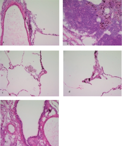 Figure 2 Particulate matter (PM) found in a) the blood vessel walls, b) lymphoid tissue, c) alveolar macrophages, d) Parenchyma, e) and airway wall, Sections from human lung tissuestained with H&E.