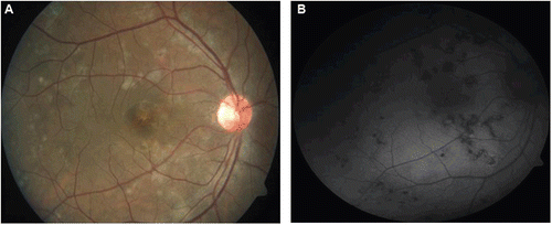 FIGURE 3  (a) Healed choroiditis lesions. (b) Fundus autofluorescence image shows no hyperautofluorescence within the lesions, suggesting no activity.