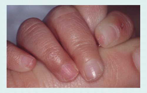 Figure 15. Nail fragility in an 8-month-old child: the distal nail plate is broken with sharp margins.