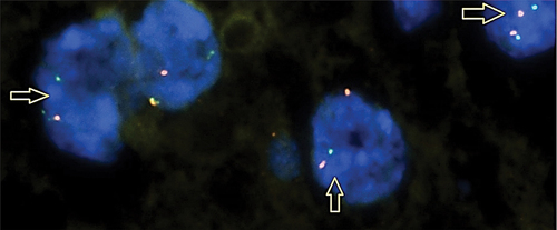 Figure 4. YAP1-rearrangement in SMEC (YAP1 break-apart probe, ×63).