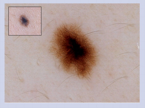 Figure 9. Acquired melanocytic nevus.Acquired melanocytic nevus showing a peripheral network with central hyperpigmentation.
