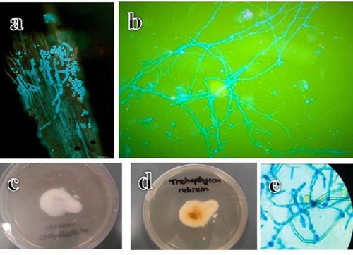 Figure 2 (A) Endothrix hair invasion with green, fluorescent hyphae and Trichophyton violaceum spores (Calcoflour white stain, fluorescent microscope, ×400). (B) Fluorescent septate hyphae of Trichophyton rubrum against a darker background in a nail sample (Calcoflour white stain, fluorescent microscope, ×100). (C) Anterior surface of a Trichophyton rubrum culture. (D) Reverse surface of a Trichophyton rubrum culture. (E) Microscope image of blue, thin walled Trichophyton rubrum macroconidia showing the clavate shape and multiseptate, smooth walled structure (lacto phenol cotton blue stain, ×100).