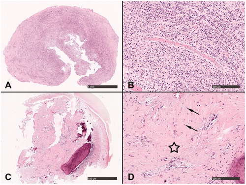 Figure 1. Biopsies showing example of application of the schedule of assessment criteria in the histopathological investigation (Table 1). (A) Infiltration of lymphocytes and plasma cells, with a higher magnification in (B), was denoted as heavy/dense general inflammation (4) and heavy infiltration of PMN cells (2). (C) Fibrous tissue with no area of inflammation (0) with a higher magnification in (D), which presents tightly packed collagen and scattered fibroblasts: only occasional possible lymphocytes (0) and no PMN cells (0). Star denotes fibrous tissue and arrows denote fibroblasts.
