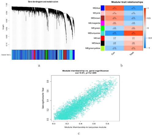 Figure 5. Creation of WGCNA modules. (a) A clustering tree of genes. The branches at the top of the image represented genes, and the rectangles at the bottom of the image were made up of various modules. (b) A chart for the module-trait relationship. The turquoise module was strongly linked to the glomerulus of FSGS. (c) Scatter plot for the correlation between module − trait connections and gene significance in the turquoise module. FSGS: focal segment glomerulosclerosis; WGCNA: weighted gene coexpression network analysis.