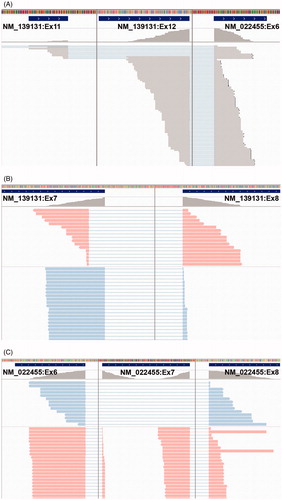 Figure 2. IGV views of two NUP98–NSD1 fusion junctions and alternatively spliced regions in the index patient detected by paired-end RNA sequencing. The figure shows supporting FASTQ-reads for fusion junctions between NUP98 exon 11/NSD1 exon 6, and between NUP98 exon 12/NSD1 exon 6 (A), alternative 5’ donor site of NUP98 exon 7 (B), and exon skipping of NSD1 exon 7 (C). The color bars on top represent different nucleotides: A (green), C (blue), T (red), and G (orange). The middle panel (grey) show RNA-sequencing data coverage. NUP98 (NM 139131) is transcribed from the – strand, and NSD1 (NM 022455) from the + strand.