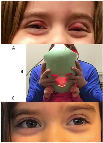 Figure 1 A young patient before LLLT treatment (A), with treatment being applied (B) and 1 week after treatment (C). Images used with permission.