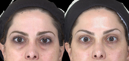 Figure 4 Before and after OnabotulinumtoxinA for eyebrow elevation.