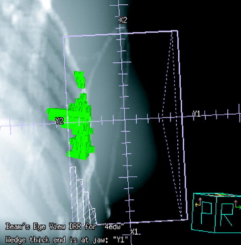 Figure 2B.  Lateral image (BEV) depicting the medial tangential photon beam. Green areas represent regions with post-RT density changes.