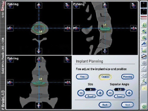Figure 2. Positioning of the artificial disc prosthesis with the navigation software.